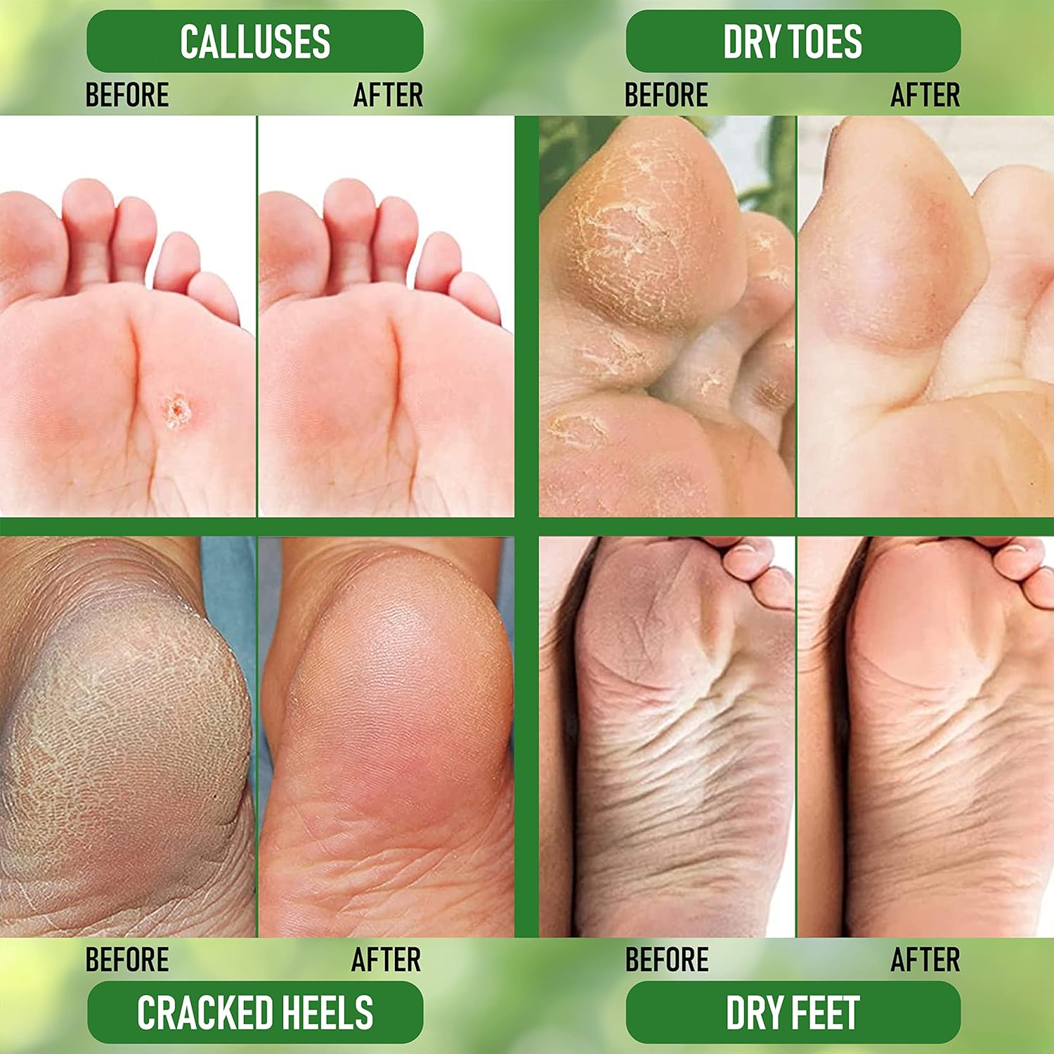 Buy now Urea 20% Healing Cream 4 oz - Best Callus Remover - Moisturizes and Rehydrates Hands, Feet and Knees to a Healthy Appearance - Soothes and Softens Thick, Cracked, Rough Dead and Dry Skin at indiglob india