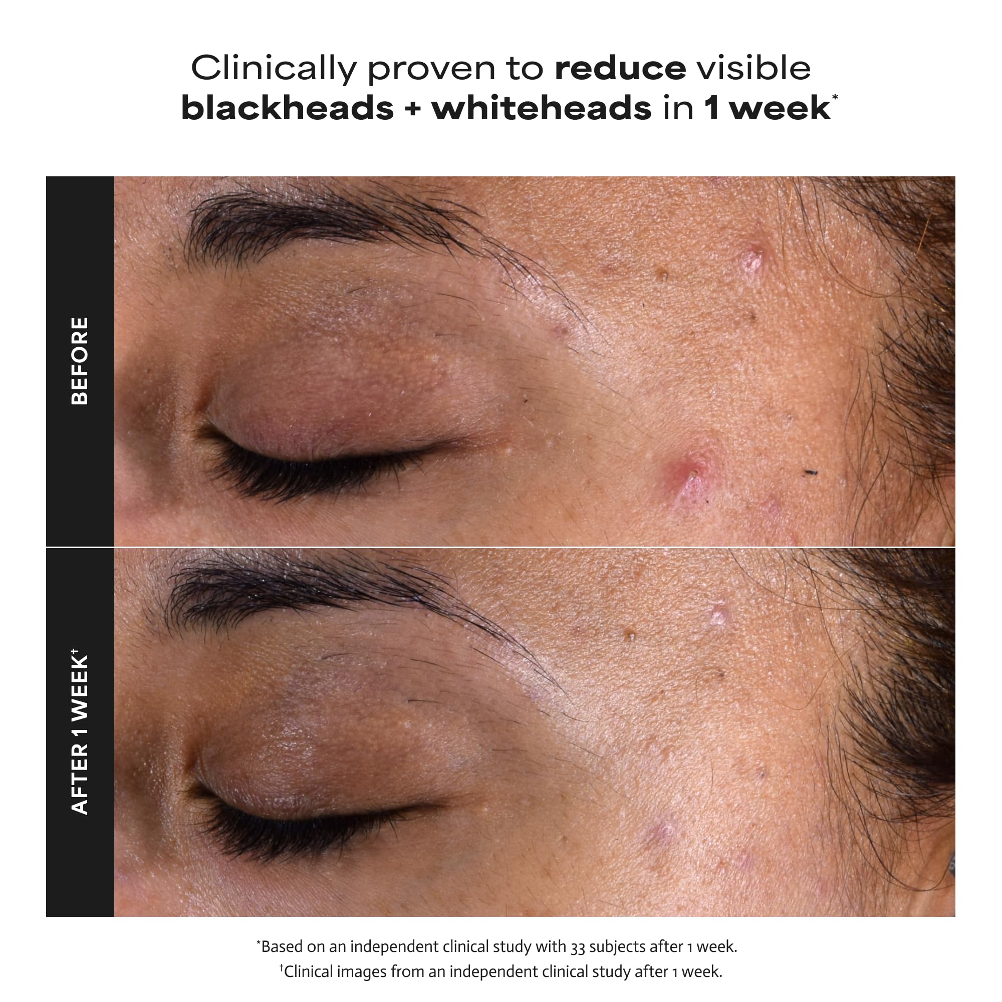 Paula's Choice SKIN PERFECTING 2% BHA Liquid Exfoliant | Gentle Salicylic Acid Facial Exfoliator for Blackheads, Enlarged Pores, Wrinkles & Fine Lines