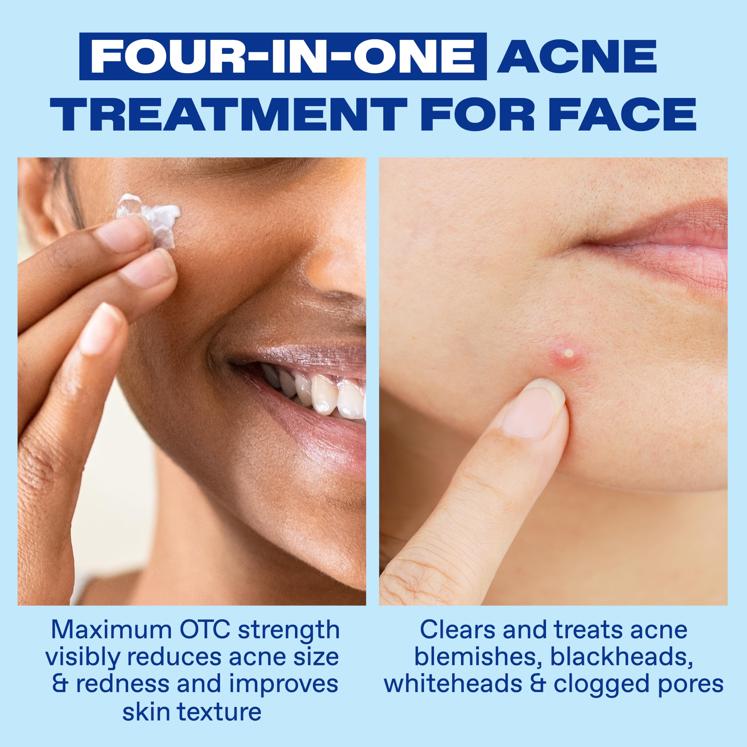 Differin Acne Spot Treatment, Max Strength, 10% Benzoyl Peroxide, 1 fl oz | Fast-Acting Pimple Treatment, Maximum Strength OTC Formula, Clears Acne Overnight, For Face, Dermatologist Brand