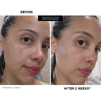Buy now Kate Somerville EradiKate 3% Sulfur Daily Foaming Cleanser Acne Treatment â€“ Clinically Formulated Medicated Face Wash Balances Skin & Cleans Pores, 4 Fl Oz at indiglob india