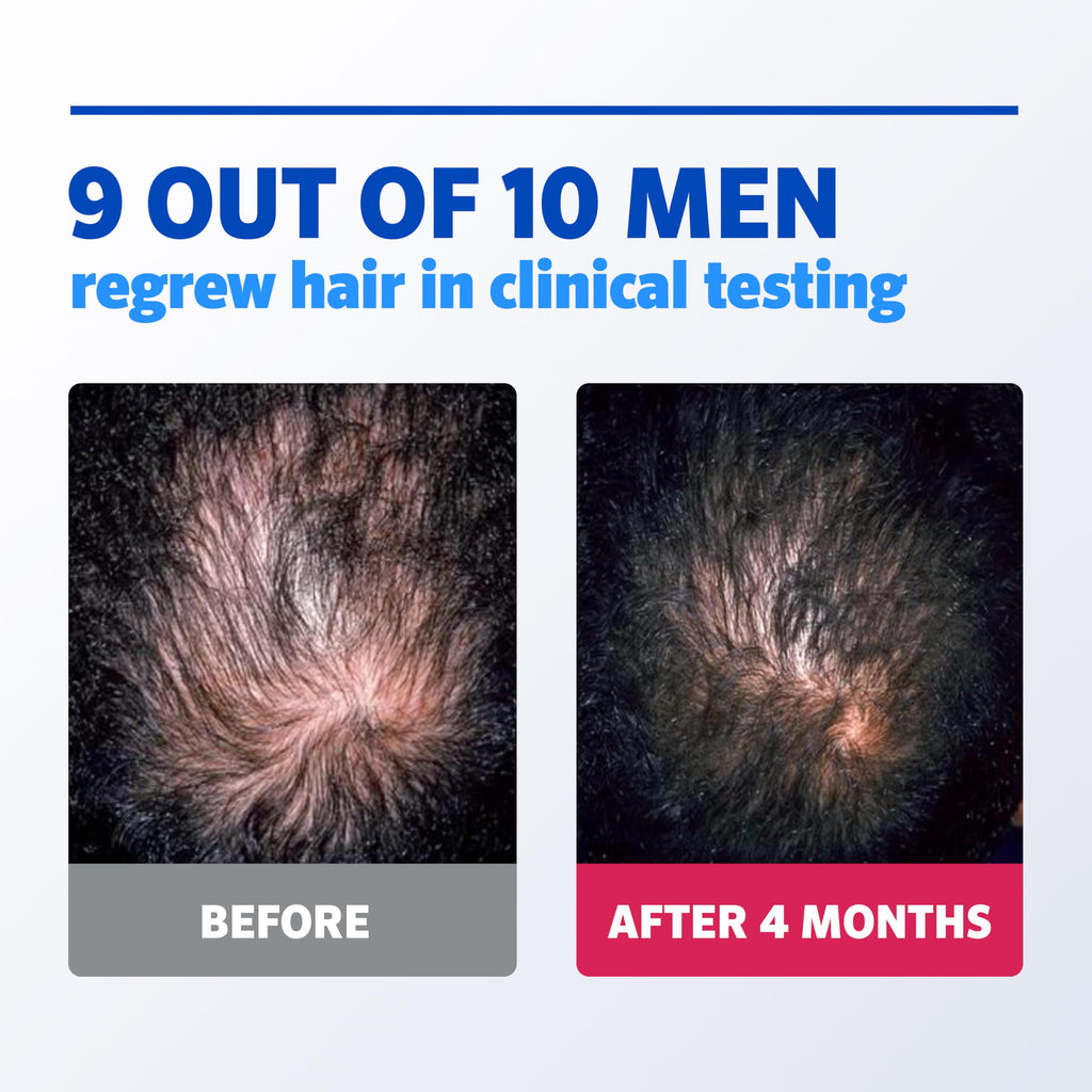Men's Rogaine 5% Minoxidil Foam, 1-Month Supply, 2.11 oz | Fuller, Thicker Hair Regrowth, Topical Hair Loss Treatment, Unscented Topical Aerosol