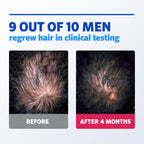 Men's Rogaine 5% Minoxidil Foam, 1-Month Supply, 2.11 oz | Fuller, Thicker Hair Regrowth, Topical Hair Loss Treatment, Unscented Topical Aerosol