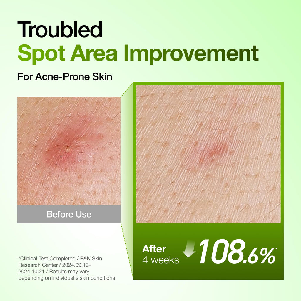 Anua Azelaic Acid 10 Hyaluron Redness Soothing Serum, 1.01 fl oz | Facial Serum for Blemish-Prone & Oily-Prone Skin, Lightweight & Hydrating Blemish Care, Hyaluronic Acid, Korean Skincare