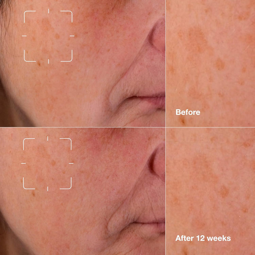 Buy now Clinique Even Better Clinical Dark Spot Clearing Vitamin C Face Serum For All Skin Types | Brightening + Soothing at indiglob india