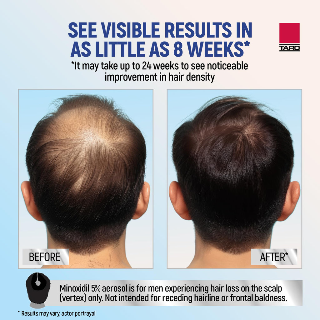 Minoxidil for Men, 2.11 Oz (1 Month Supply) Clinically Proven to Regrow Hair, Topical Aerosol Foam 5%, Hair Thinning Treatment