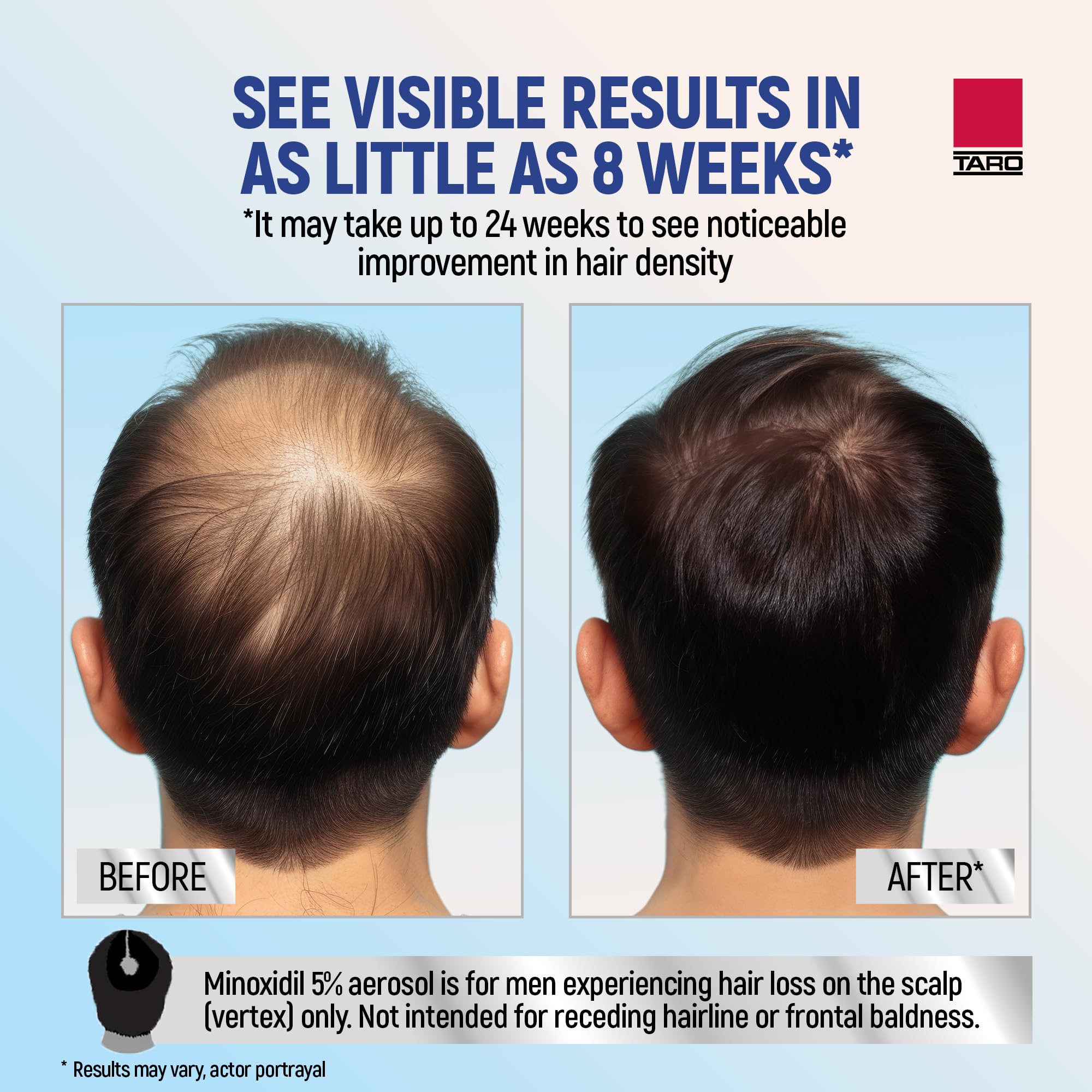 Minoxidil for Men, 2.11 Oz (1 Month Supply) Clinically Proven to Regrow Hair, Topical Aerosol Foam 5%, Hair Thinning Treatment