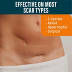 Buy now NUVADERMIS Silicone Scar Sheets - Extra Long Scar Sheets for C-Section, Tummy Tuck, Keloid, and Surgical Scars - Reusable Medical Grade Silicone Scar Sheets - Pack of 4 - Light Tone at indiglob india