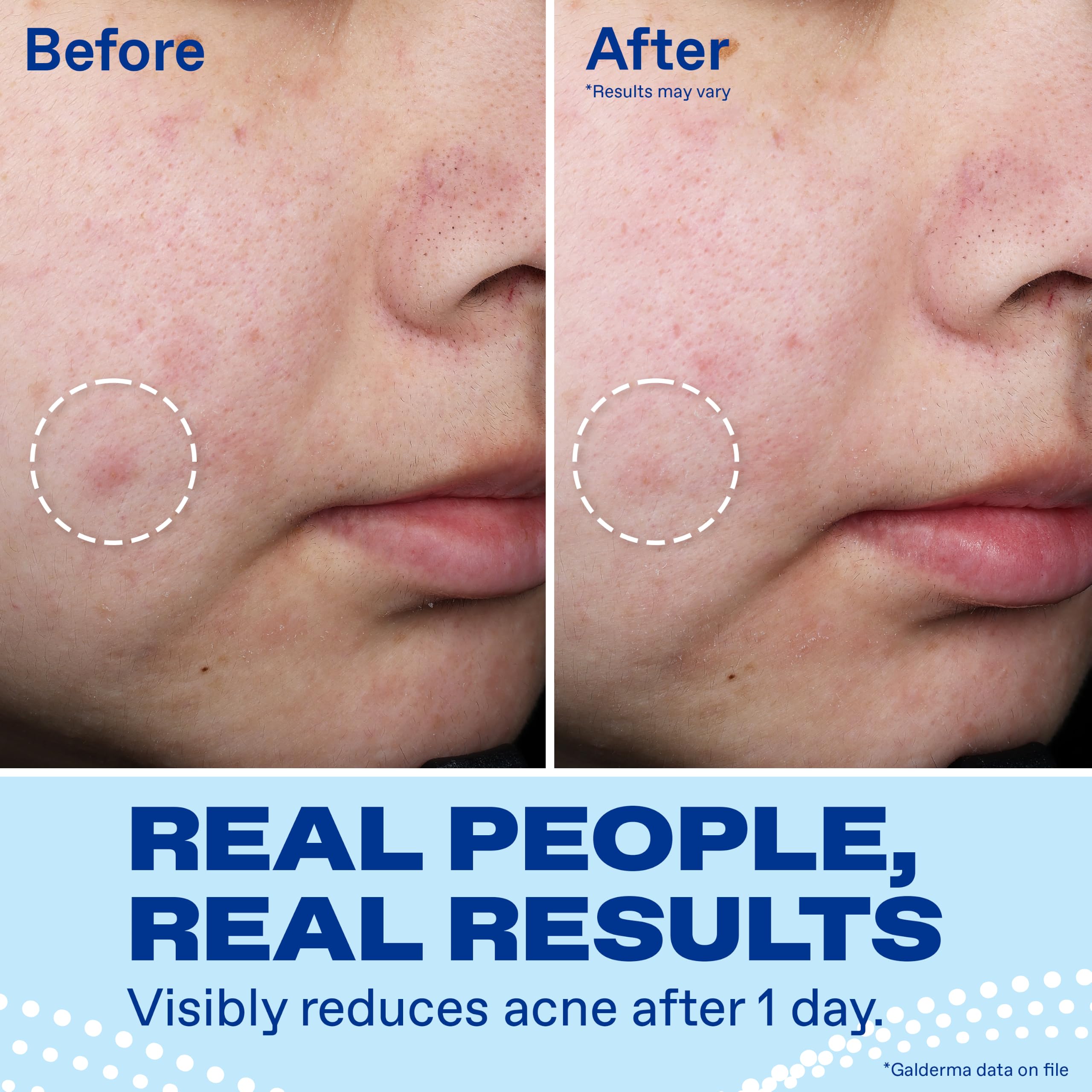Differin Acne Spot Treatment, Max Strength, 10% Benzoyl Peroxide, 1 fl oz | Fast-Acting Pimple Treatment, Maximum Strength OTC Formula, Clears Acne Overnight, For Face, Dermatologist Brand