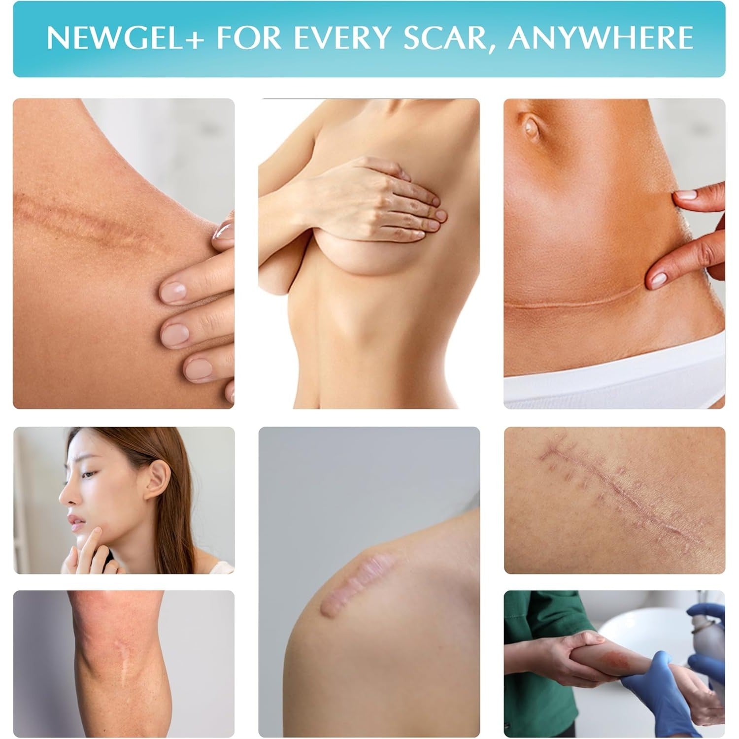 Buy now Advanced High-Potency Silicone Scar Gel with Vitamin E for Old, New Scars, Surgery, Keloids, Burns, and Facial Blemish Scars, NewGel Plus by MyNewGel (15 Grams) - 0.50 oz at indiglob india