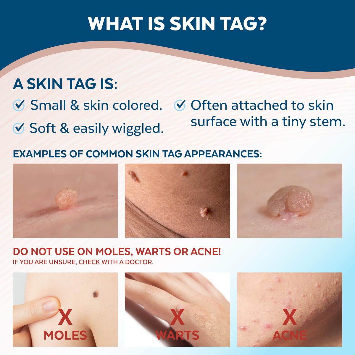 Claritag Advanced Skin Tag Remover, FDA-Cleared Freeze-Off Kit