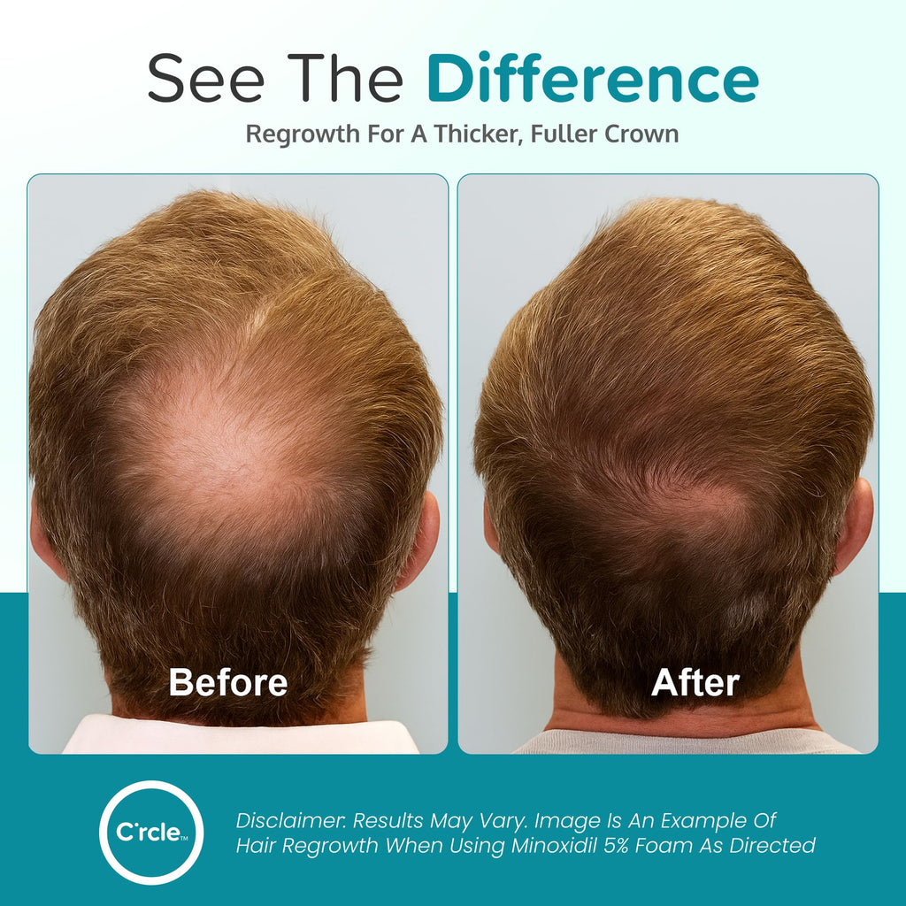 Minoxidil for Men Foam 5%, Unscented 3 Month Supply, Supports Hair Regrowth | Helps Restore Vertex Hair Loss & Thinning, Extra Strength 5% Minoxidil Foam For Men