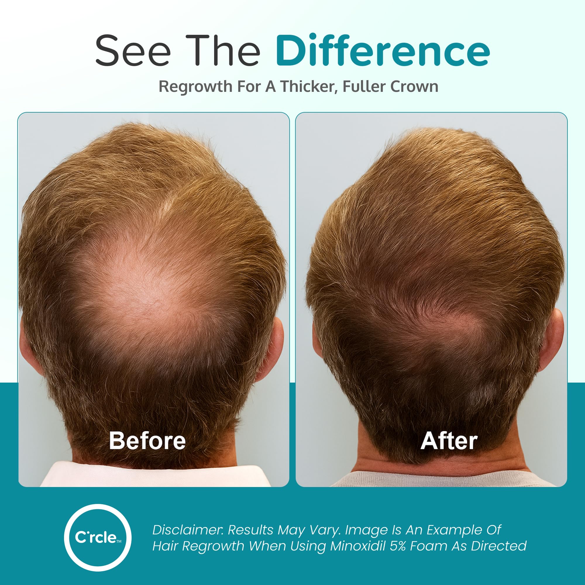Minoxidil for Men Foam 5%, Unscented 3 Month Supply, Supports Hair Regrowth | Helps Restore Vertex Hair Loss & Thinning, Extra Strength 5% Minoxidil Foam For Men