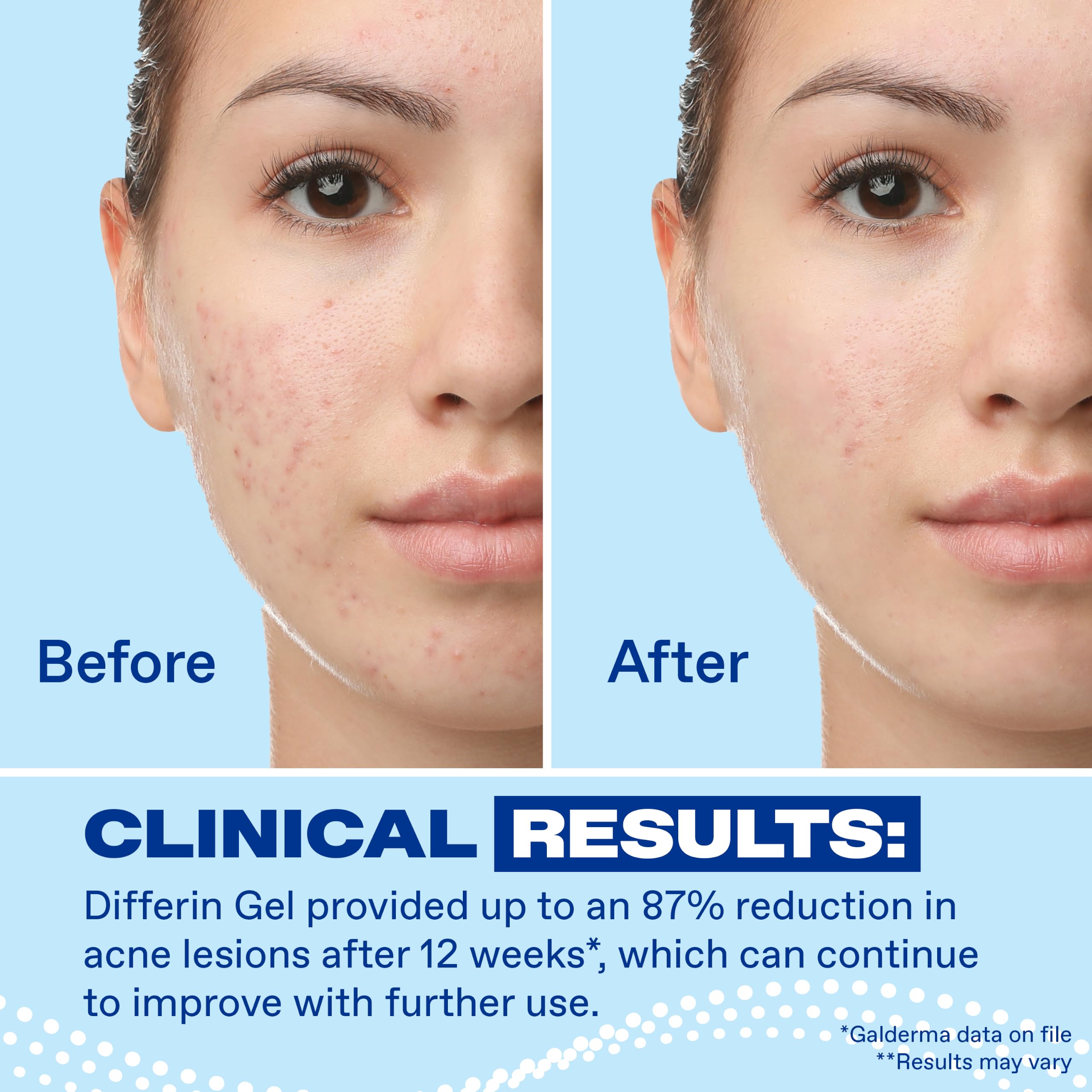 Differin Acne Retinoid Treatment Gel, 0.1% Adapalene, 45g Pump | 90-Day Supply Pump, Over-The-Counter Retinoid, Clears Breakouts, Gentle For Sensitive Skin, Dermatologist Recommended