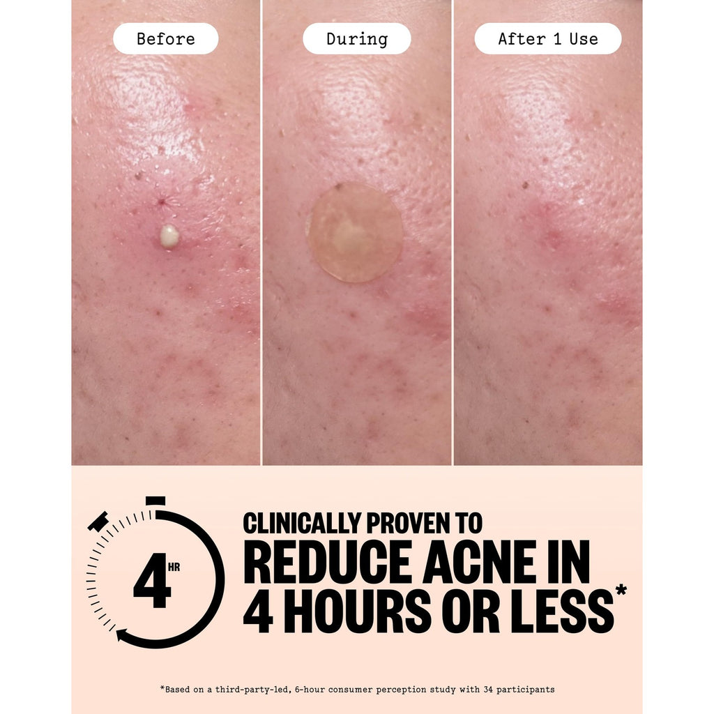 PEACE OUT Acne Healing Dots Hydrocolloid Pimple Patches (60 count) | Fast Acting Acne Spot Treatment for Blemishes & Breakouts with Salicylic Acid, Retinol and Aloe Vera, Award Winning Skincare