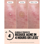 PEACE OUT Acne Healing Dots Hydrocolloid Pimple Patches (60 count) | Fast Acting Acne Spot Treatment for Blemishes & Breakouts with Salicylic Acid, Retinol and Aloe Vera, Award Winning Skincare