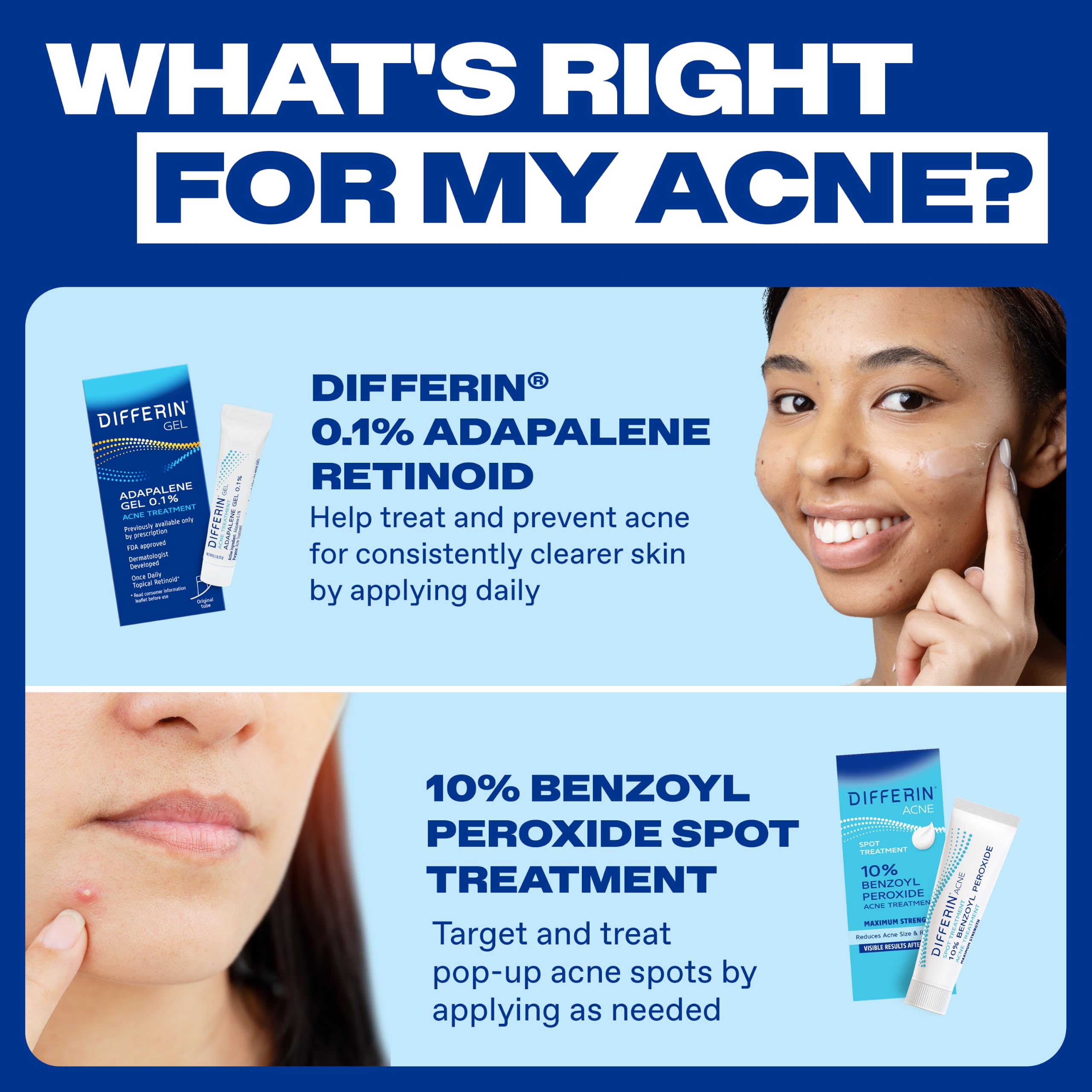 Differin Acne Spot Treatment, Max Strength, 10% Benzoyl Peroxide, 1 fl oz | Fast-Acting Pimple Treatment, Maximum Strength OTC Formula, Clears Acne Overnight, For Face, Dermatologist Brand
