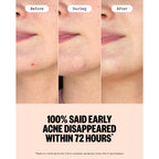 PEACE OUT Early Stage Acne Microneedling Hydrocolloid Dots (8 Count)