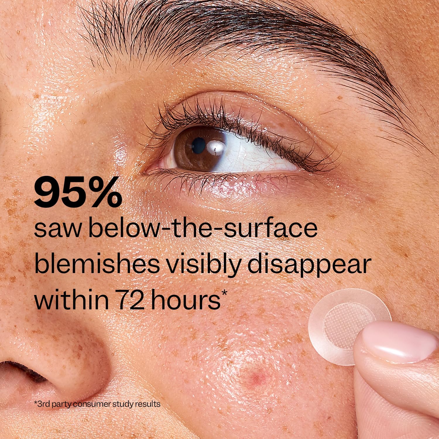 Peach Slices - Deep Blemish Microdarts (9 ct) - Early Stage Pimple Patches for Face - Salicylic Acid, Niacinamide, Hyaluronic Acid, Tea Tree Oil & Cica - Vegan, Cruelty Free, Korean Skin Care & Beauty | Salicylic Acid