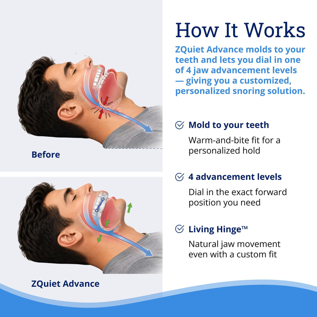 ZQuiet Advance Custom Anti-Snoring Mouthpiece, 4-Level Jaw Advancement