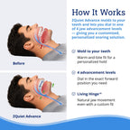 ZQuiet Advance Custom Anti-Snoring Mouthpiece, 4-Level Jaw Advancement
