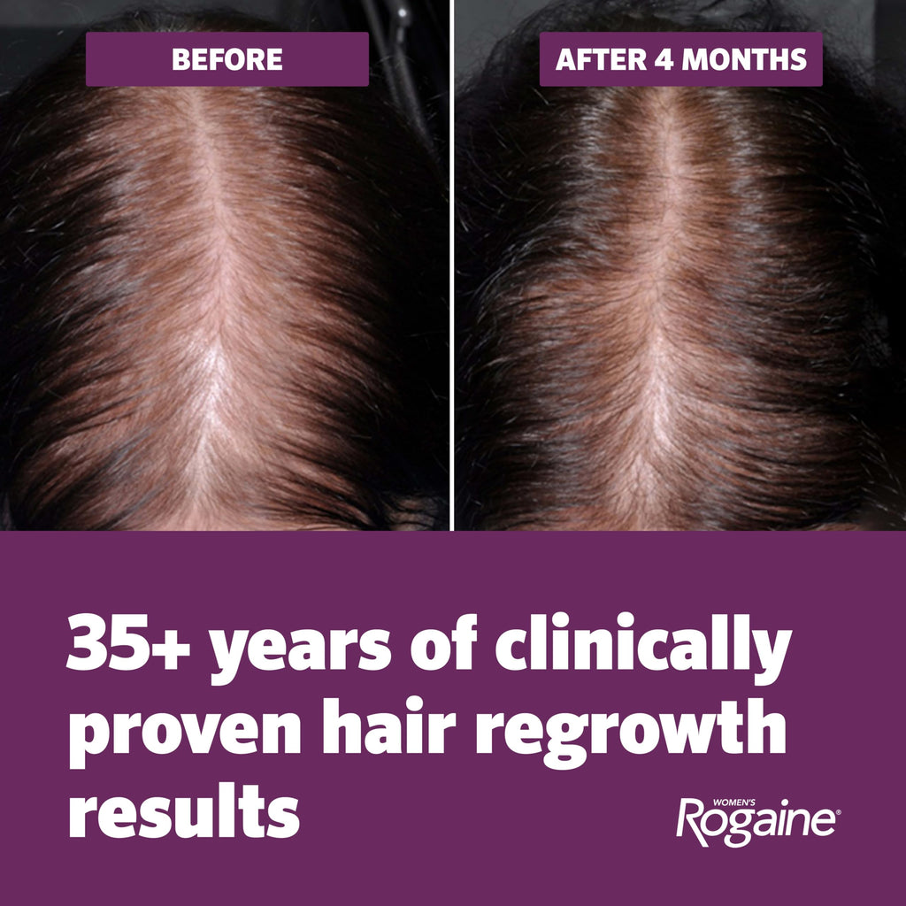 Women's Rogaine Hair Growth Foam, 5% Topical Minoxidil, 4 Mo, 2x 2.11 Oz