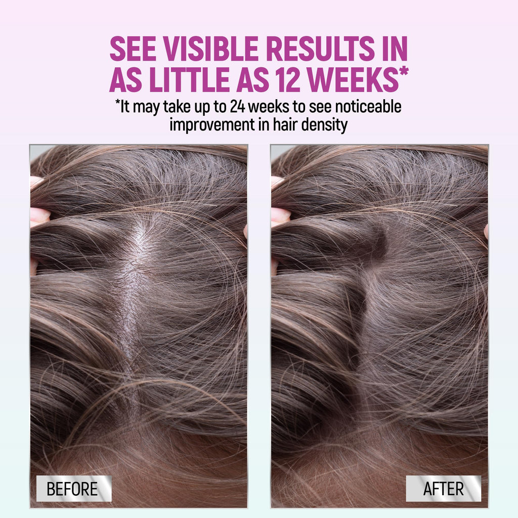 Minoxidil for Women, 2.11 Oz (2 Months Supply) Clinically Proven to Regrow Hair, Topical Aerosol Foam 5%, Hair Thinning Treatment