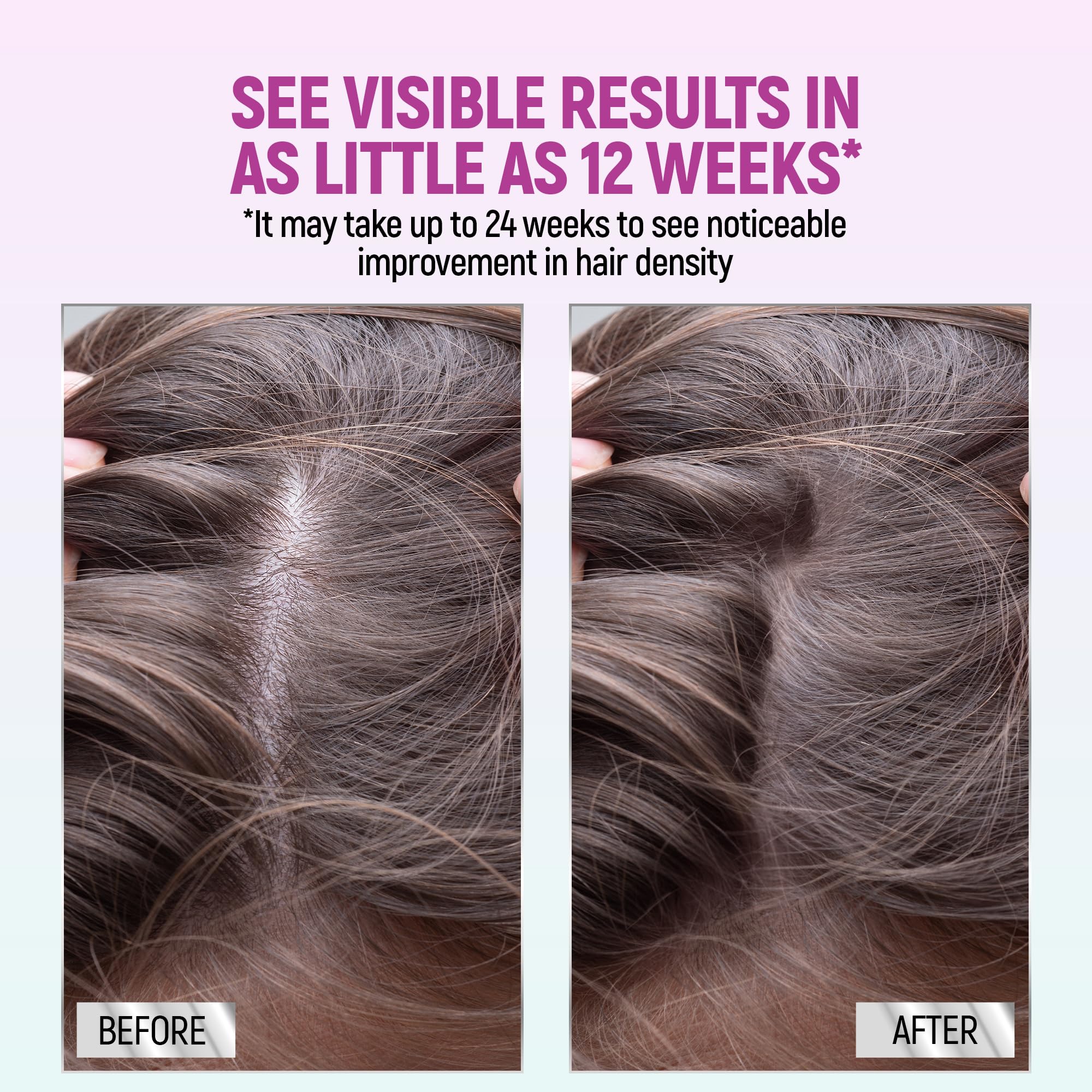Minoxidil for Women, 2.11 Oz (2 Months Supply) Clinically Proven to Regrow Hair, Topical Aerosol Foam 5%, Hair Thinning Treatment