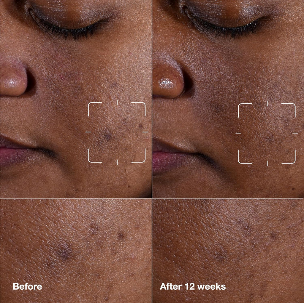 Buy now Clinique Even Better Clinical Dark Spot Clearing Vitamin C Face Serum For All Skin Types | Brightening + Soothing at indiglob india