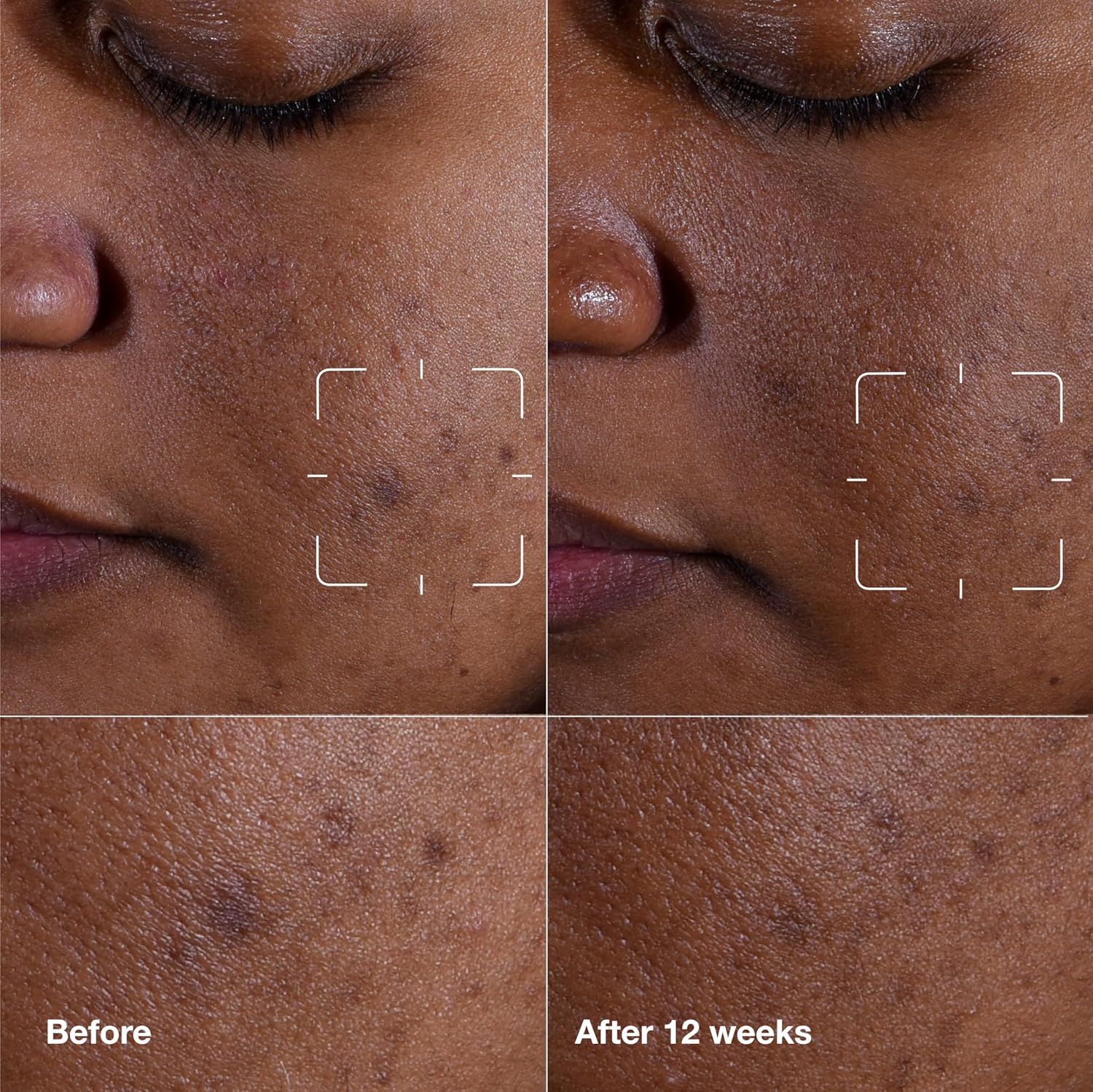 Buy now Clinique Even Better Clinical Dark Spot Clearing Vitamin C Face Serum For All Skin Types | Brightening + Soothing at indiglob india