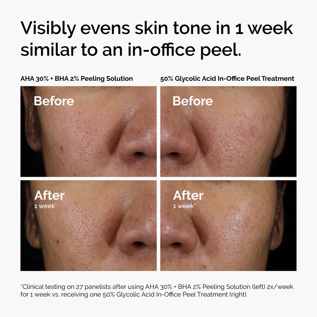 The Ordinary AHA 30% + BHA 2% Peeling Solution, Advanced Exfoliating Peel for Brighter Skin