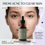 Before and after photos showing the blemish-control results of CURAT CART Face Serum on acne and uneven texture.