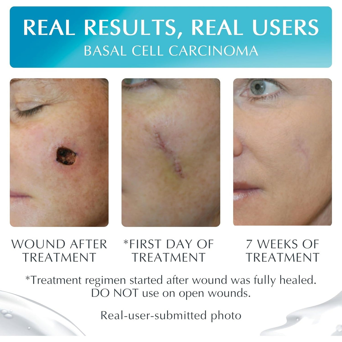 Premium imported NewGel Plus visibly reduces scars over 7 weeks. Real results from actual users showcased.