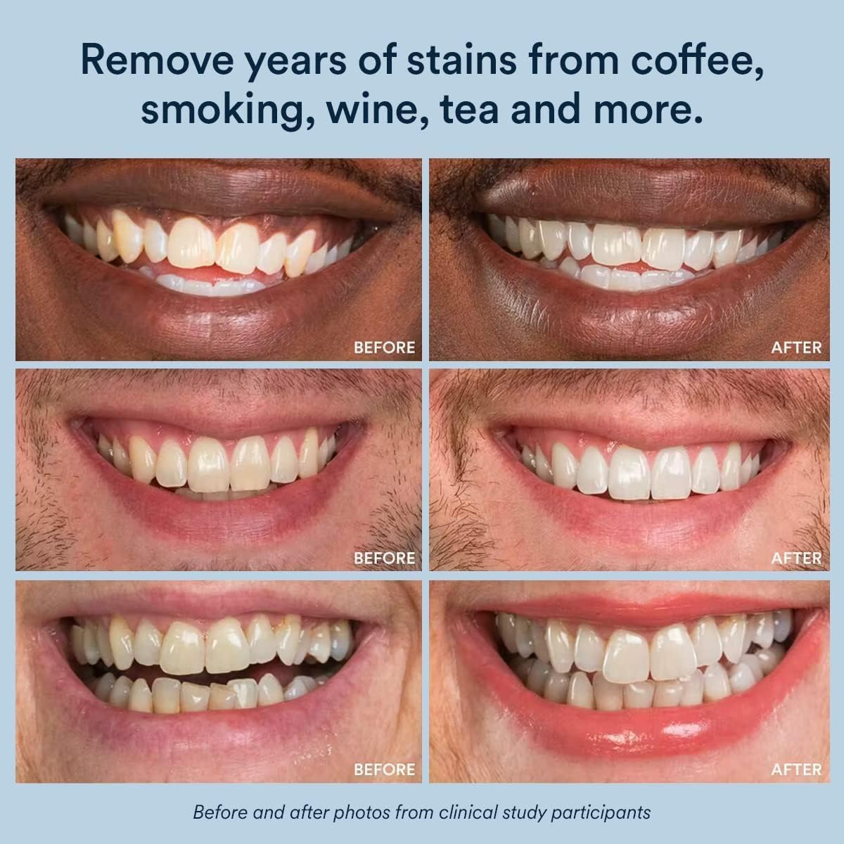 Transform your smile with Auraglow Teeth Whitening Strips. 100% Authentic, available at Curat Cart in India.