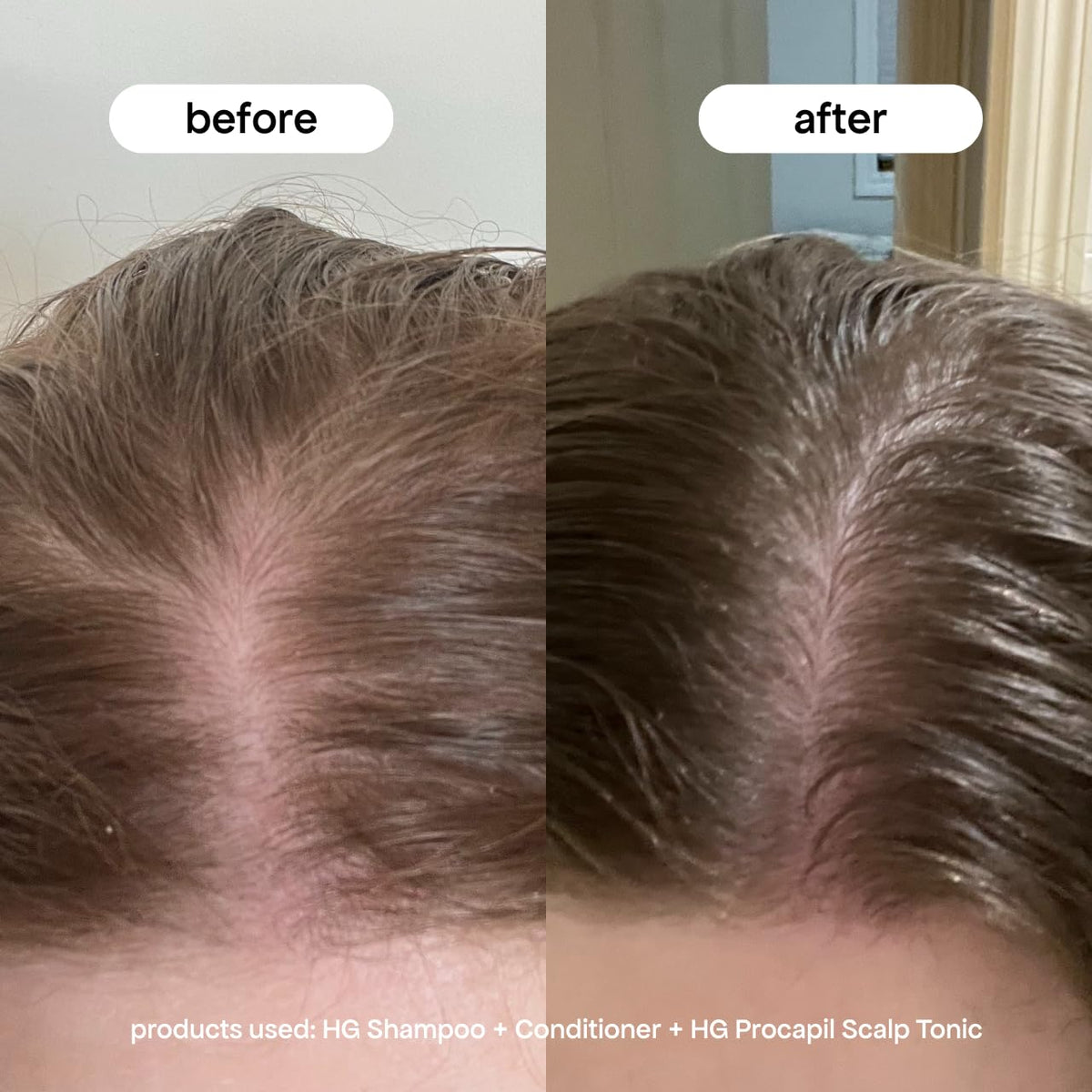 Transform your hair with BONDIBOOST Procapil Scalp Treatment. 100% Authentic, available at Curat Cart in India.