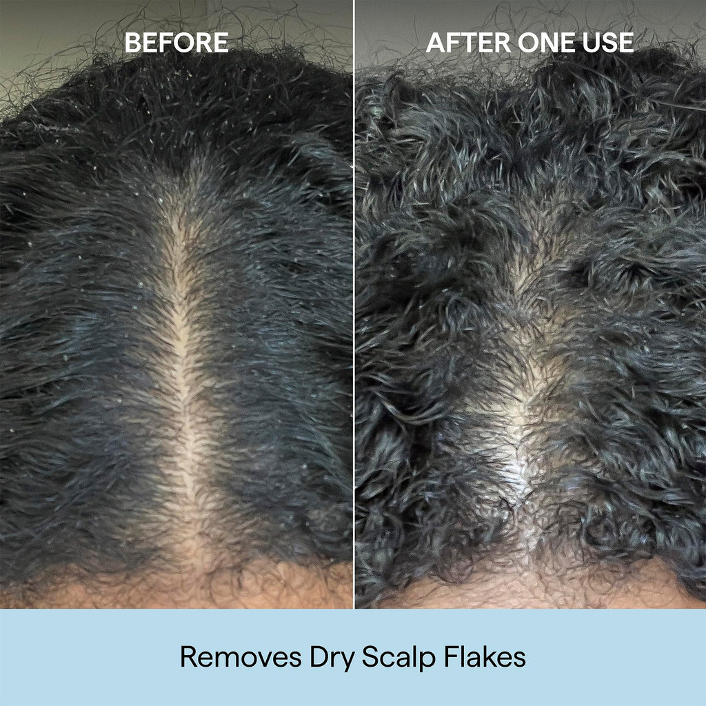 Transform your scalp with Briogeo Scalp Revival. Premium formula removes flakes, showing noticeable results after just one use.