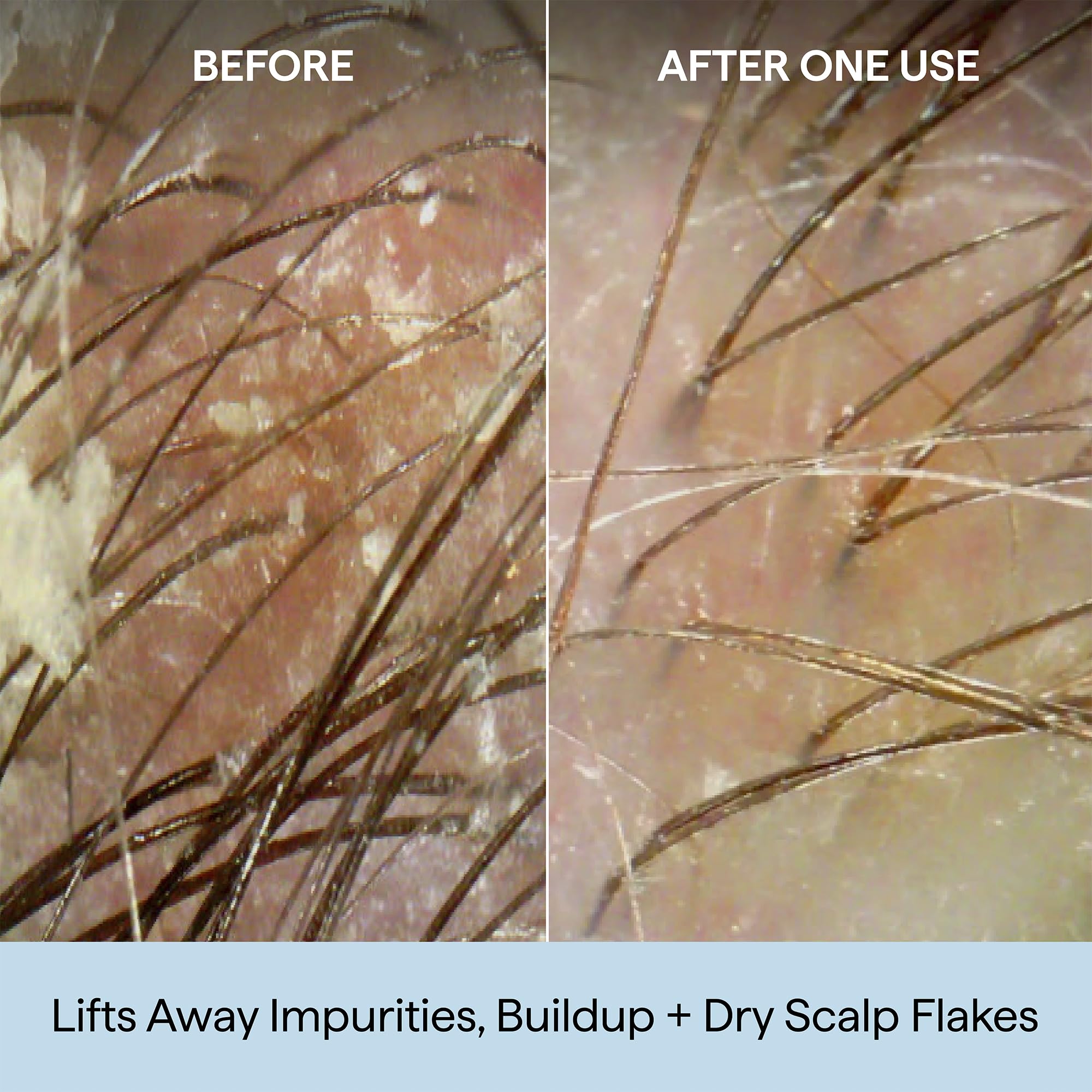 Before and after images showing scalp treatment effectiveness, removing impurities and flakes for healthier hair.