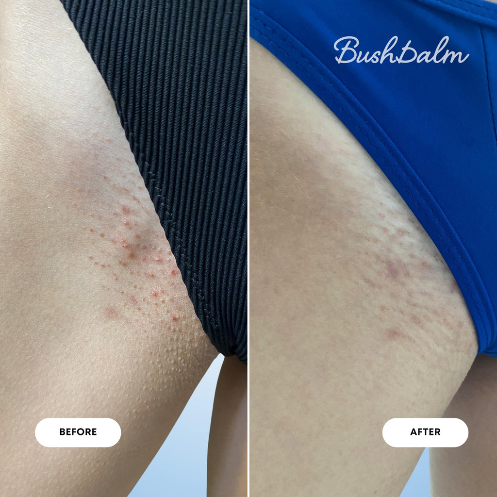 Transformation showing skin before and after using Bushbalm 2-Step Ingrown Hair Routine. Available for order online.