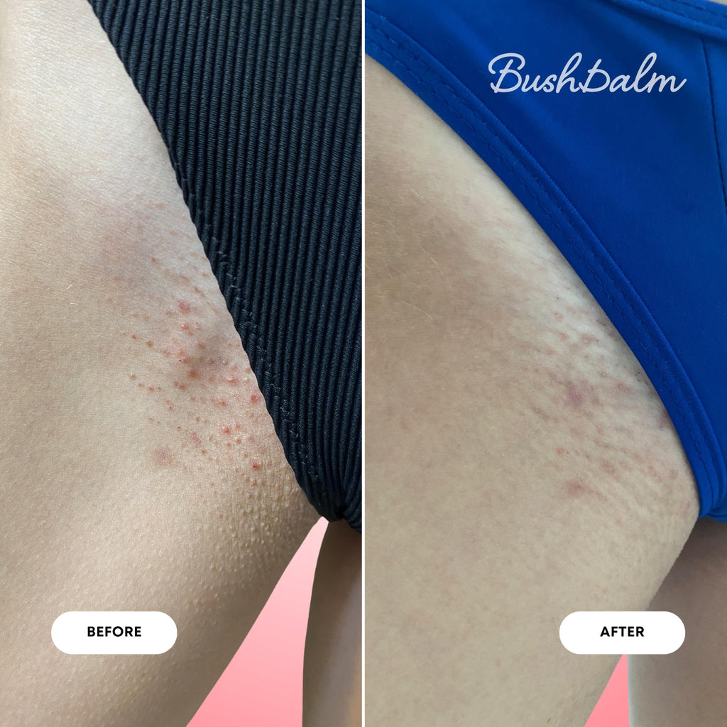 Before and after images showcasing the effectiveness of Bushbalm's 2-Step Ingrown Hair Routine for smoother skin.