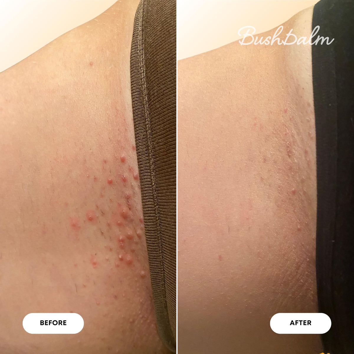 Transform your skin with Bushbalm Ingrown Hair & Razor Bumps Oil. Verified by CuratCart for visible results.