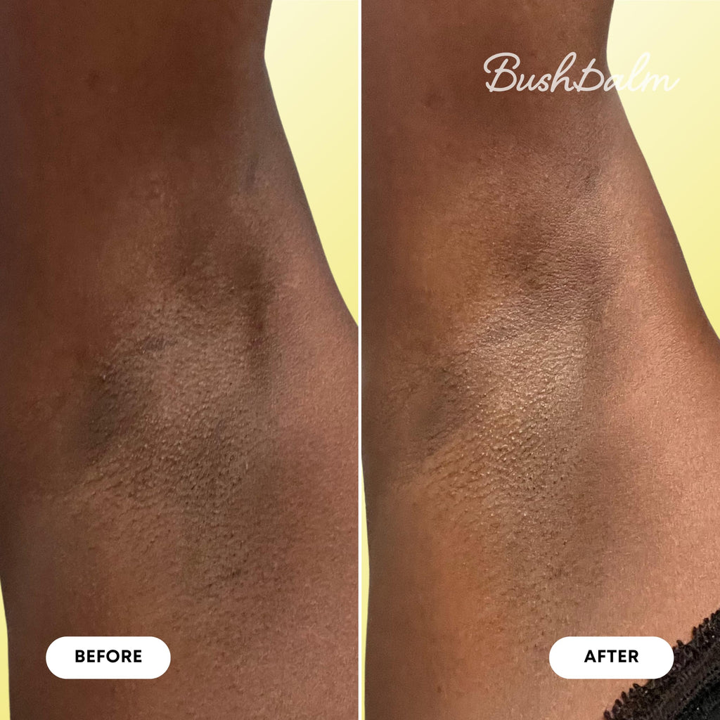 Authentic Bushbalm Ingrown Hair & Razor Bumps Oil, showing effective before and after results on skin.