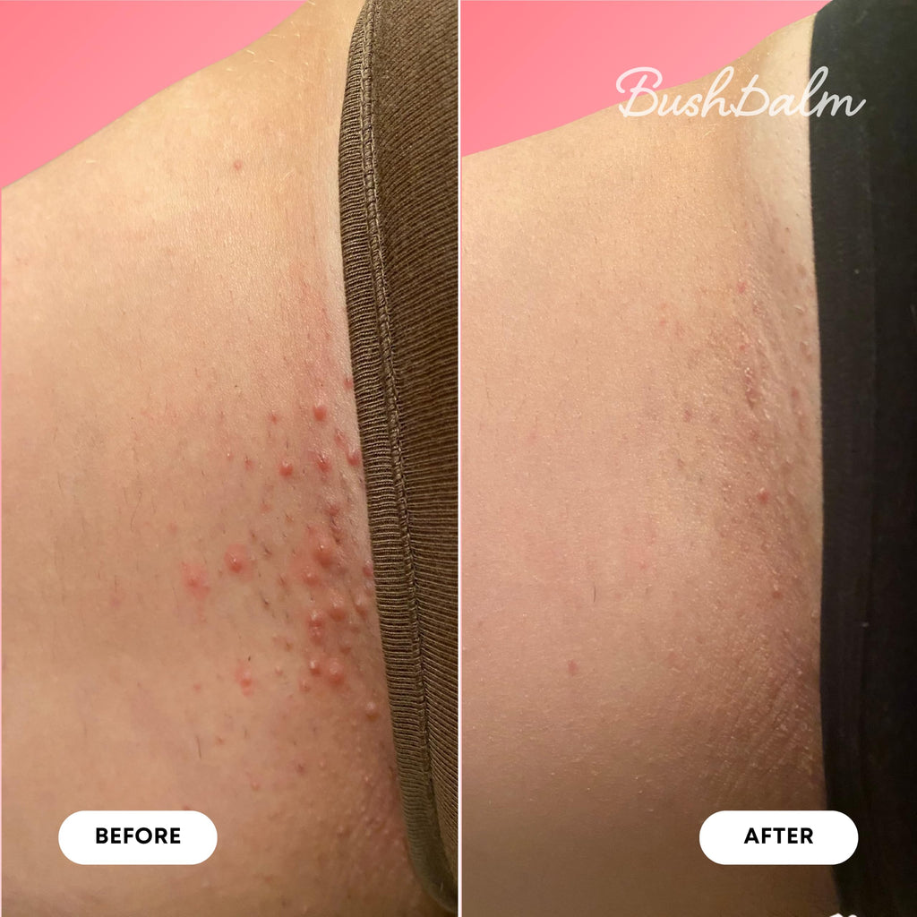 Before and after image of skin using Bushbalm Ingrown Hair & Razor Bumps Oil, showcasing clear skin results.