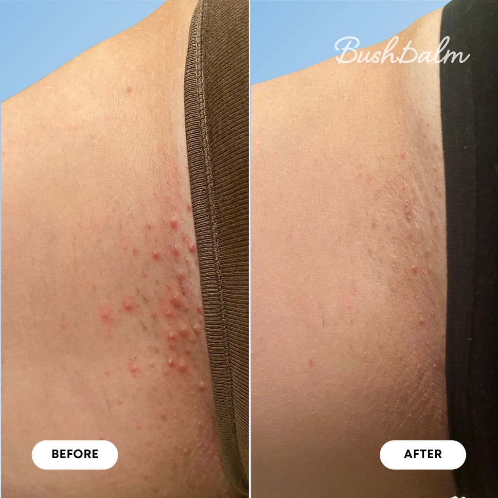 Before and after photos showing the effectiveness of Bushbalm Ingrown Hair & Razor Bumps Oil for smoother skin.