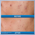 CeraVe Acne Control Gel Treatment - Texture, Swatch & Consistency | original imported packaging available on Curat Cart India