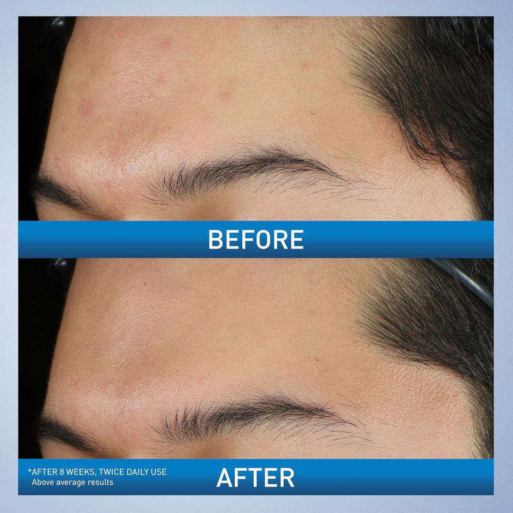 CeraVe Acne Foaming Cream Wash - Side Profile & Box Packaging | original imported packaging available on Curat Cart India
