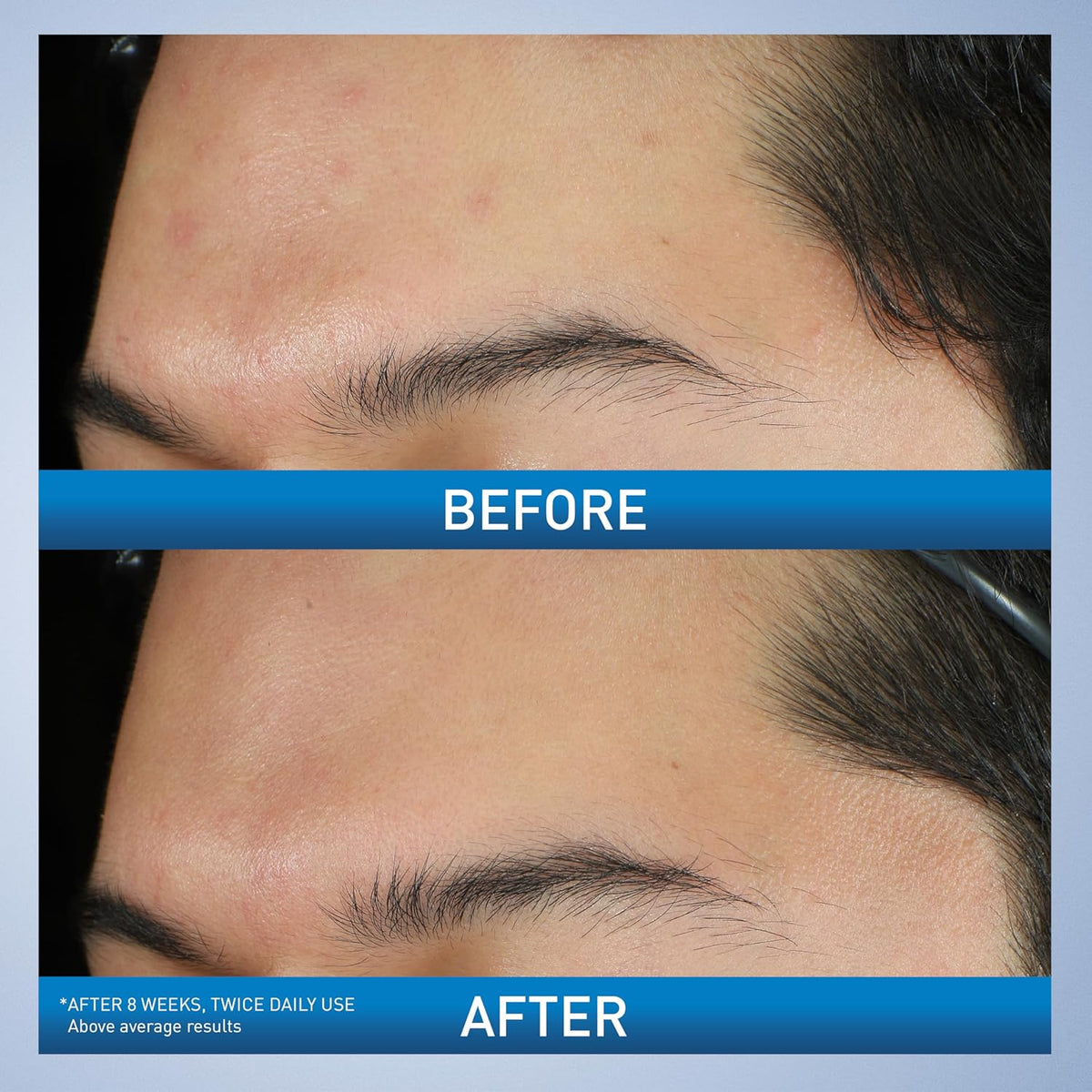 CeraVe Acne Foaming Cream Wash - Side Profile & Box Packaging | original imported packaging available on Curat Cart India