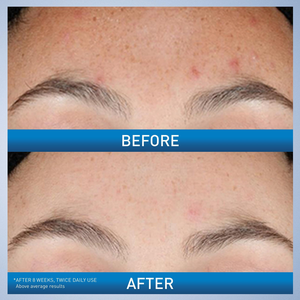 CeraVe Resurfacing Retinol Serum - Front Packaging & Bottle View | buy 100% authentic product online in India via Curat Cart