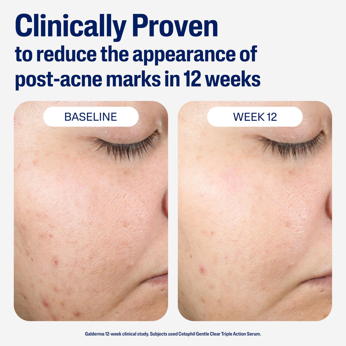 CETAPHIL Gentle Clear Serum showcases 12-week results in reducing post-acne marks, highlighting effective skin transformation.