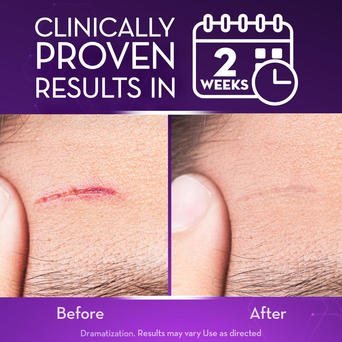Clinically proven results in 2 weeks for scar healing. Experience global favorite Cicatricure Advanced Scar Gel.