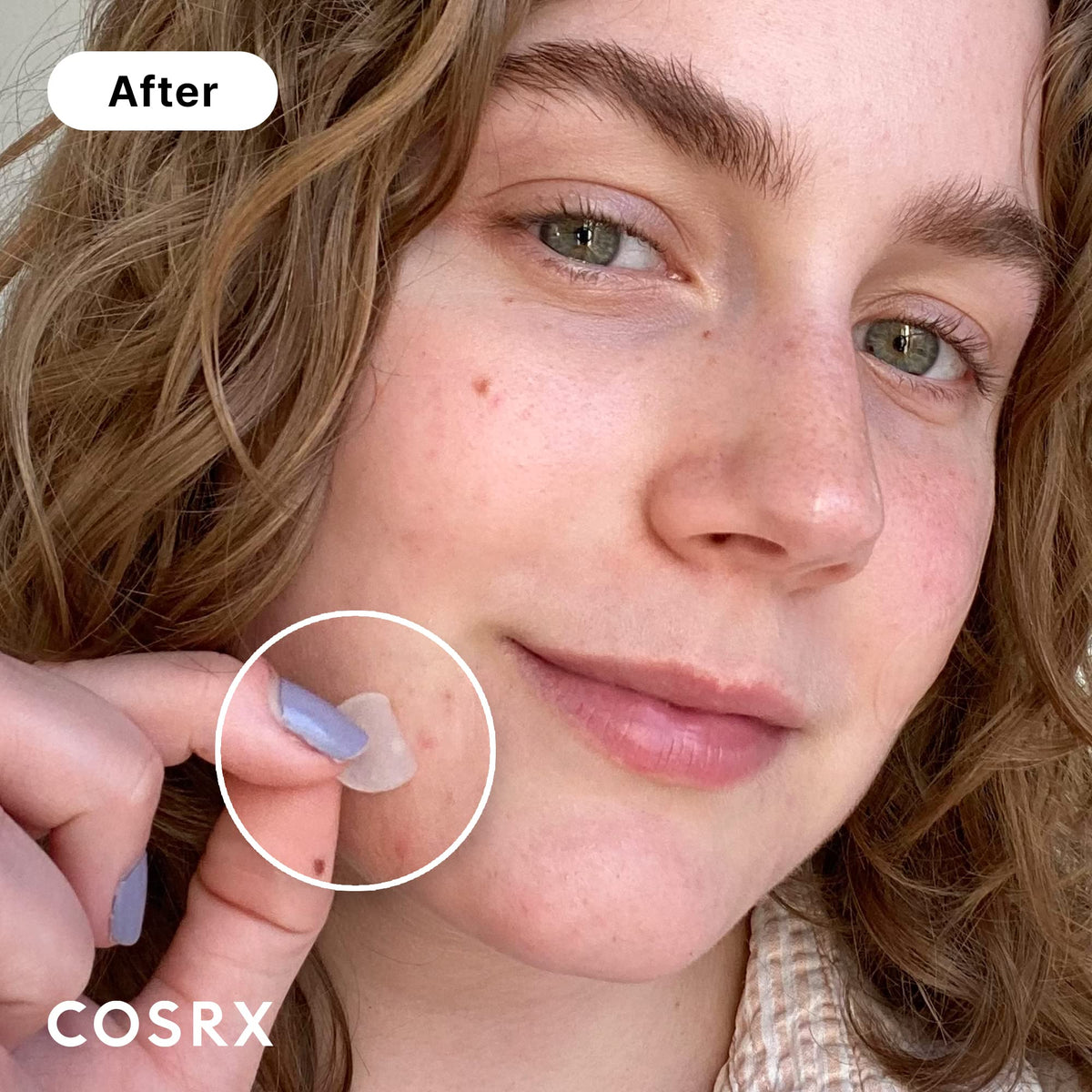 COSRX Acne Pimple Patch Original, a premium imported solution for targeted acne treatment, visibly effective on blemishes.