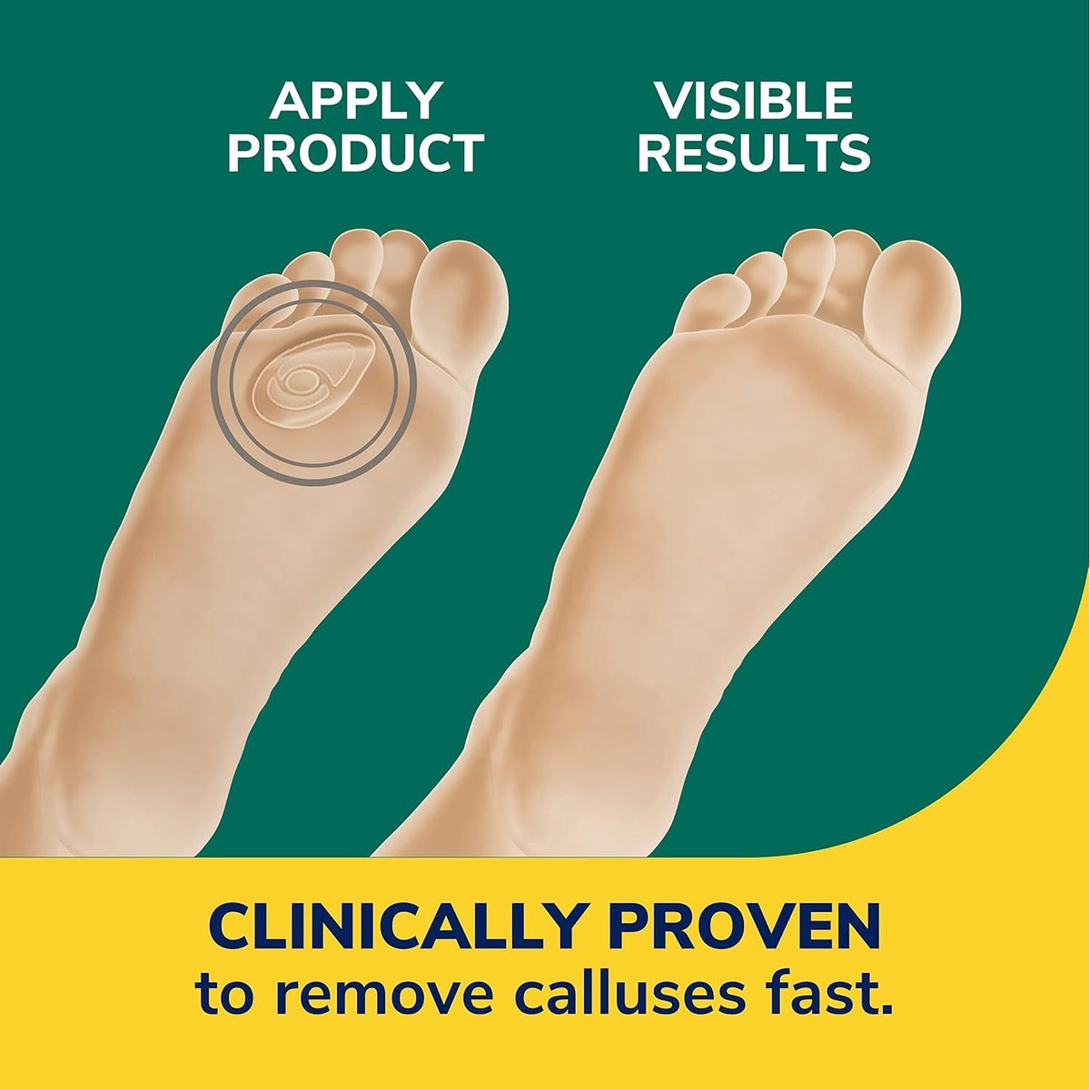 Premium imported Dr. Scholl's Callus Remover Bandage, clinically proven for fast callus removal. Experience visible results.